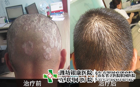 头皮银屑病对比图