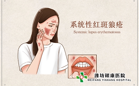 红斑狼疮是什么症状_系统性红斑狼疮图片