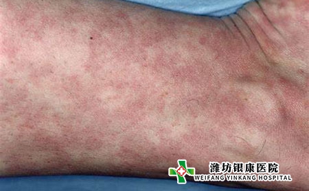 红斑狼疮是怎么引起的_红斑狼疮能治愈吗