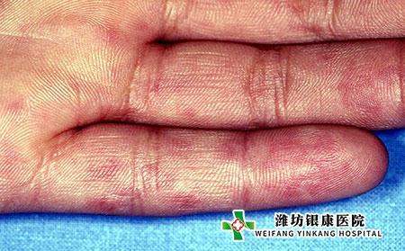 系统性红斑狼疮诊断_女性红斑狼疮早期症状图片