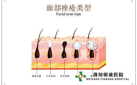 痤疮用什么药膏最好