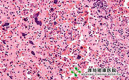 头皮红斑狼疮图片症状 头皮红斑狼疮图片症状