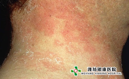头皮脂溢性皮炎图片 头皮脂溢性皮炎图片