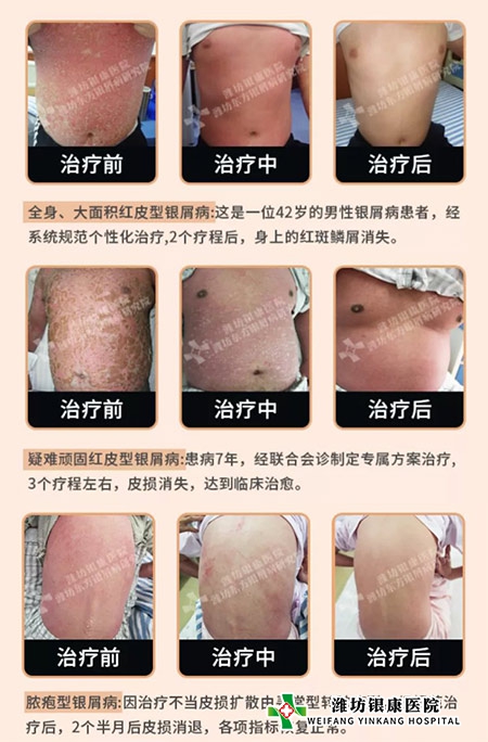 皮肤病康复前后对比图_潍坊银康皮肤病医院