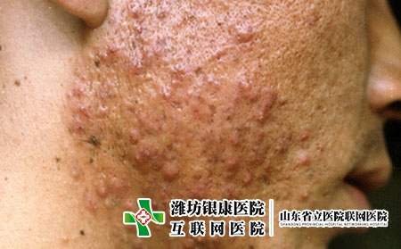 囊肿性痤疮图片症状是什么样子