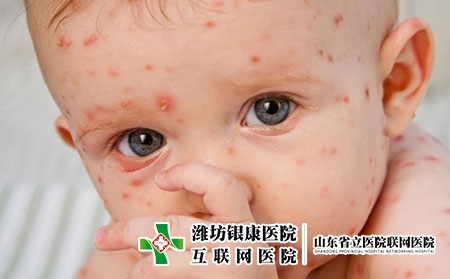 婴儿水痘初期症状图片