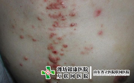 痤疮长什么样子的图片