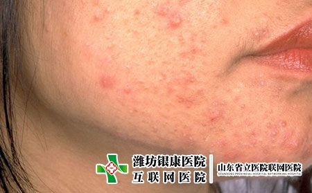 痤疮会不会长一辈子