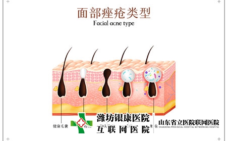 痤疮怎么治
