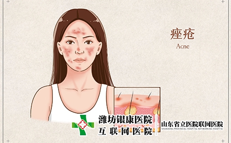痤疮一般多久可以自愈