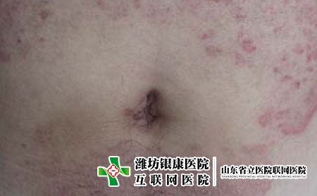 6[潍坊市皮肤病医院专找银康]体癣严重有什么危害有哪些?