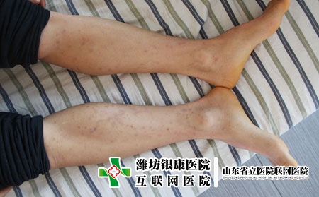 [潍坊医院看皮肤病]潍坊市治疗皮肤癣都用哪些方法