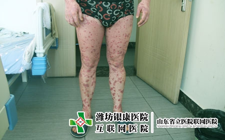[银屑病皮肤病医院]潍坊市治疗皮肤癣医院在哪儿