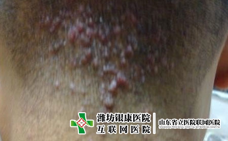 [潍坊皮肤病银康a专看]毛囊炎的主要危害是什么?