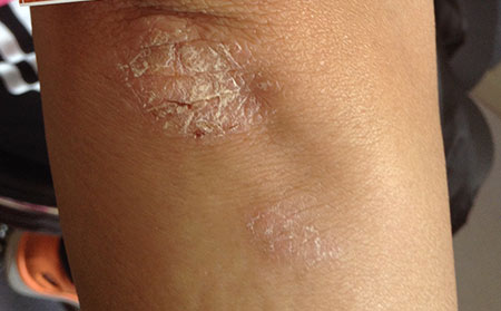 湿疹和皮肤癣的症状