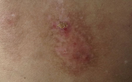 湿疹和皮肤癣的图片