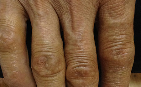 湿疹和皮肤癣的表现有哪些