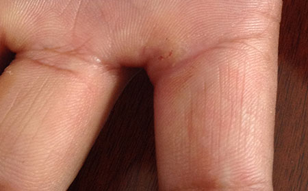 湿疹和皮肤癣什么样