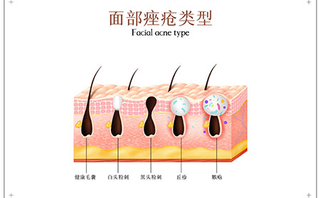 面部痤疮类型