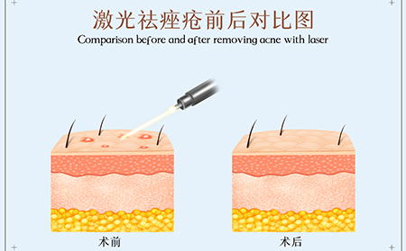 激光祛除痤疮示意图