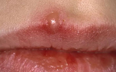 唇疱疹症状图片