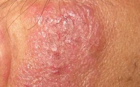 潍坊湿疹的症状都有哪些表现，山东潍坊皮肤科医院优先银康