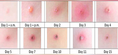 水痘15天症状发展过程图片