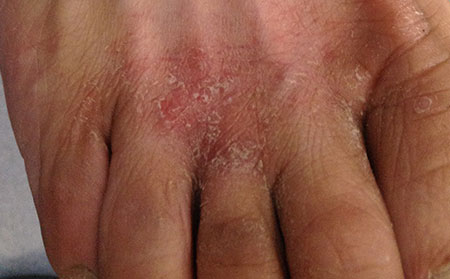 潍坊湿疹是怎么引起的，什么会导致湿疹发作