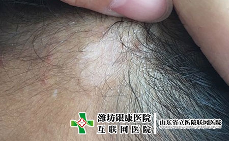 白癜风应该如何治疗?怎么正确治疗白癜风