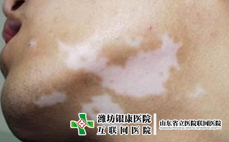 为什么白癜风长期治疗无效?白癜风老不好是为什么