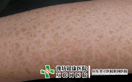 鱼鳞病病因有哪些呢?为什么得鱼鳞病