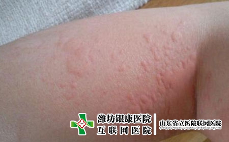 听潍坊医生说皮肤过敏的危害，过敏不治疗会怎样