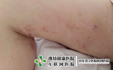 潍坊治疗皮肤过敏医院怎么选，银康治过敏怎么样