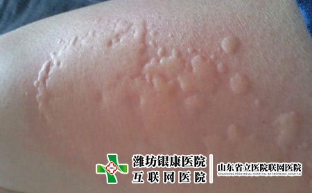 是什么原因导致的皮肤过敏，为什么会皮肤过敏