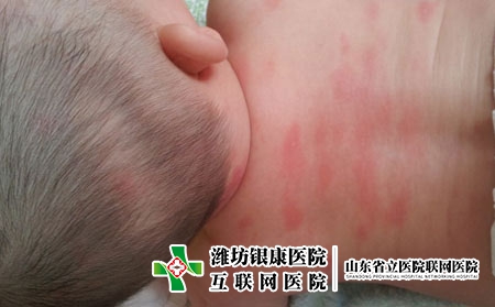 夏季为什么皮肤容易过敏，什么会导致皮肤过敏