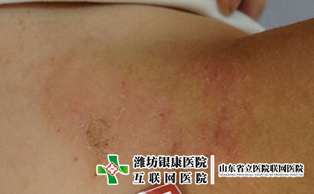 湿疹要注意的地方是什么，湿疹日常如何护理