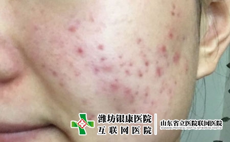 潍坊治疗皮炎的医院哪家效果好，潍坊银康治皮炎好