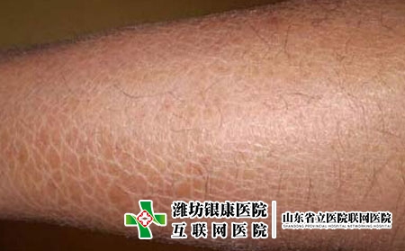 20鱼鳞病的初期症状特点是什么，鱼鳞病刚开始什么样