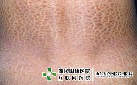鱼鳞病的初期症状特点，怎么分辨是不是鱼鳞病