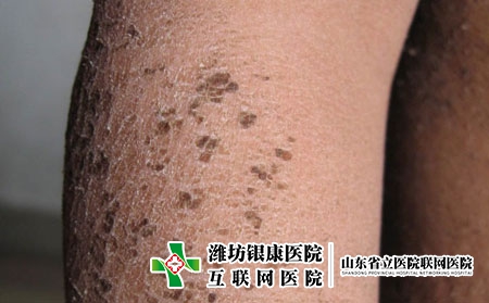鱼鳞病的病因有哪些呢，鱼鳞病是怎么得的