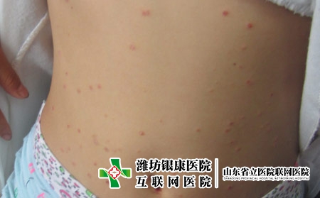 牛皮癣患者能美容整形吗，牛皮癣能不能做医美