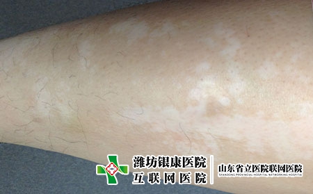 发生白癜风疾病后患者该怎么办，有白癜风怎么办