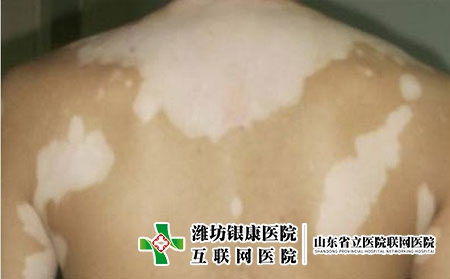 治疗腰部白癜风应该怎么做，身上白癜风怎么消除