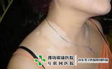 白癜风早期治疗要注意什么，白癜风刚开始注意什么