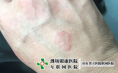 荨麻疹患者有哪些注意事项,荨麻疹有什么生活禁忌 荨麻疹患者有哪些注意事项,荨麻疹有什么生活禁忌