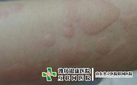 荨麻疹平时要避免什么，荨麻疹老反复要注意什么