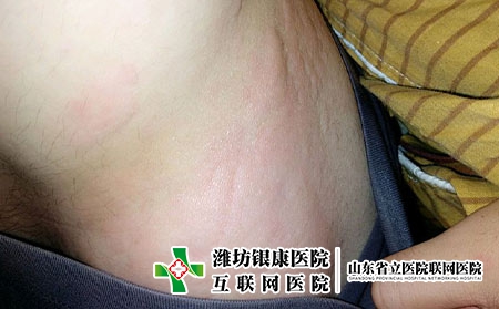 荨麻疹人群需避免的事项，什么会导致荨麻疹反复