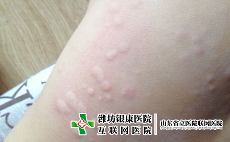 潍坊治疗皮肤过敏的医院，潍坊银康专业