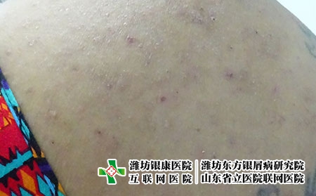 湿疹有哪些不同的症状体现，湿疹有哪些种