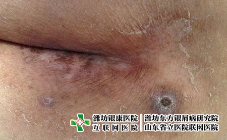 湿疹有哪些病因呢，为什么得湿疹